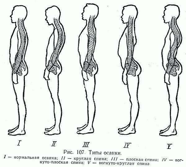 Сколиоз.