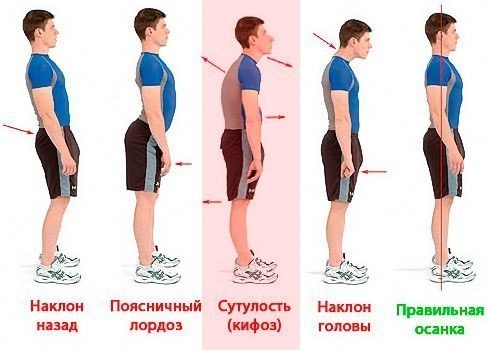 Важность правильной осанки