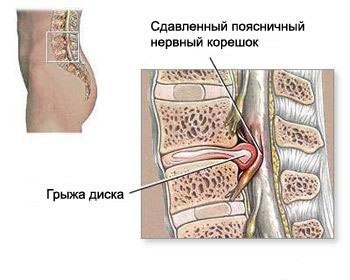 Могут ли занятия силовыми видами спорта спровоцировать развитие межпозвоночных грыж?