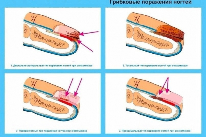 КАК ВЫЛЕЧИТЬ ГРИБОК НА НОГТЯХ КАК ВЫЛЕЧИТЬ ГРИБОК НА НОГТЯХ