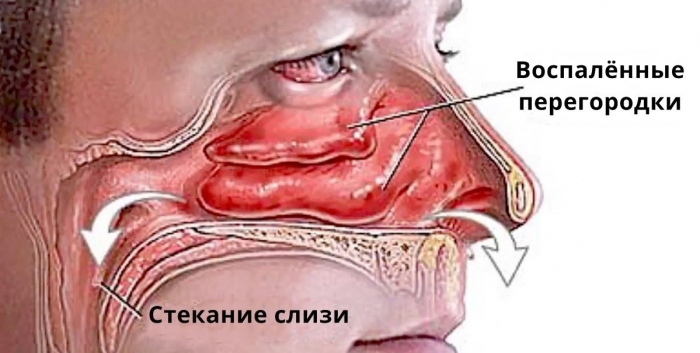 ЕСТЬ 3 СПОСОБА ИЗБАВИТЬСЯ ОТ НАСМОРКА ЗА 30 МИНУТ ЕСТЬ 3 СПОСОБА ИЗБАВИТЬСЯ ОТ НАСМОРКА ЗА 30 МИНУТ