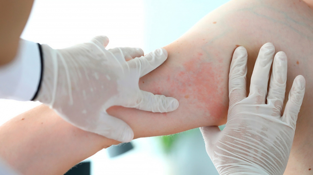 Лечение псориаза.