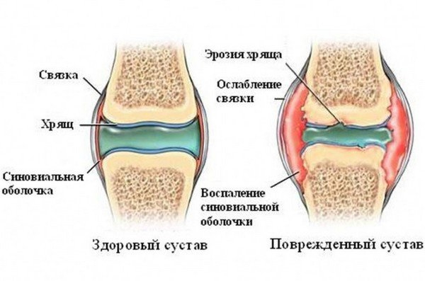 Причины суставной боли.