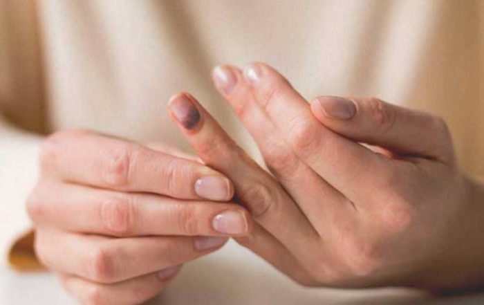Если вы защемили палец дверью – что делать: первая помощь. Если вы защемили палец дверью – что делать: первая помощь.