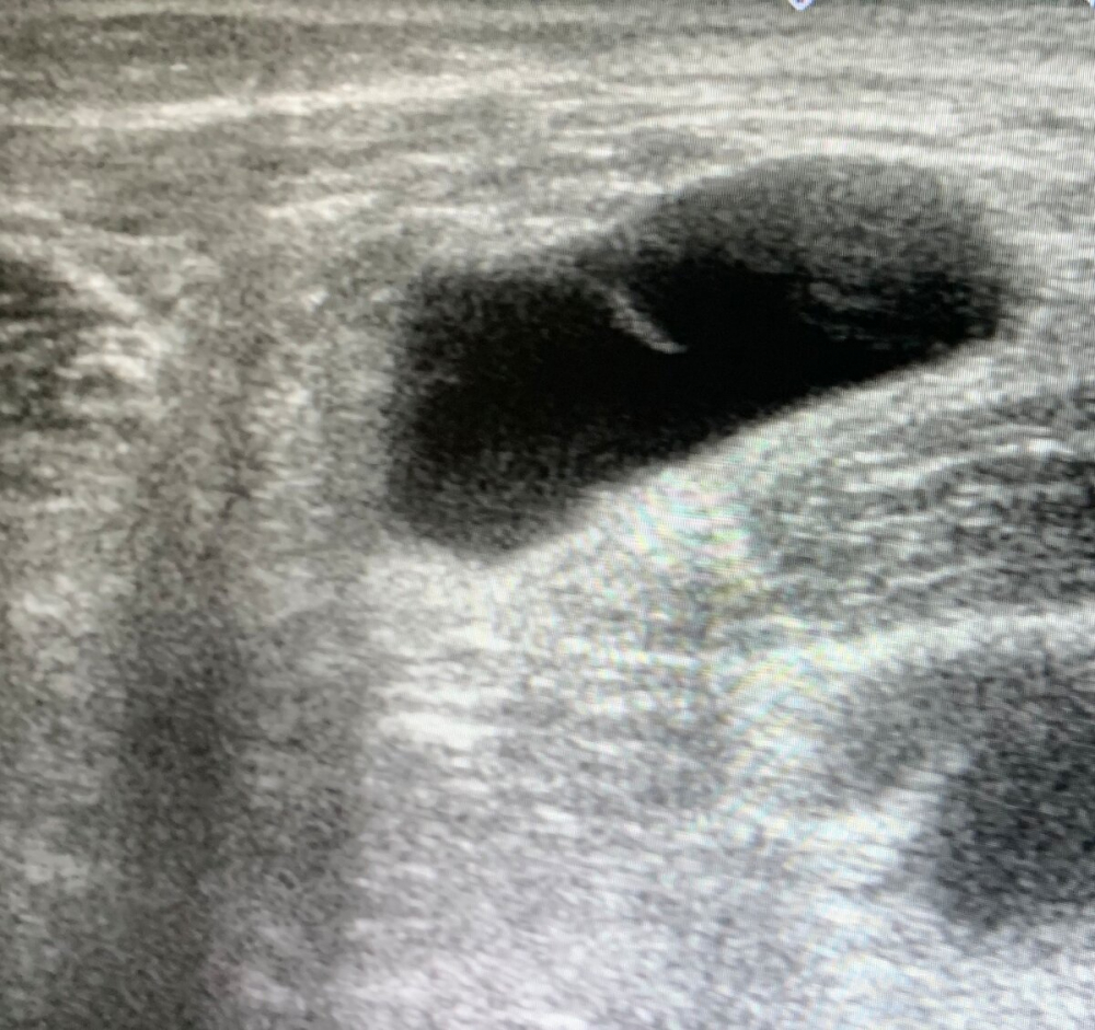 «Шишка на руке»: гигрома и как от нее избавиться?