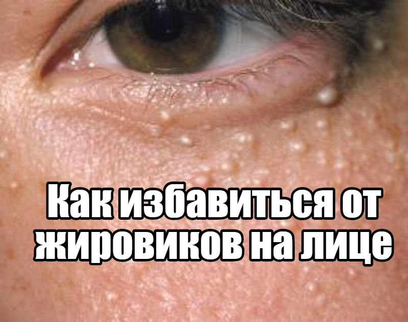 Липома. Как избавиться от жировиков на лице?