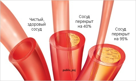 Какие существуют способы понизить уровень холестерина?